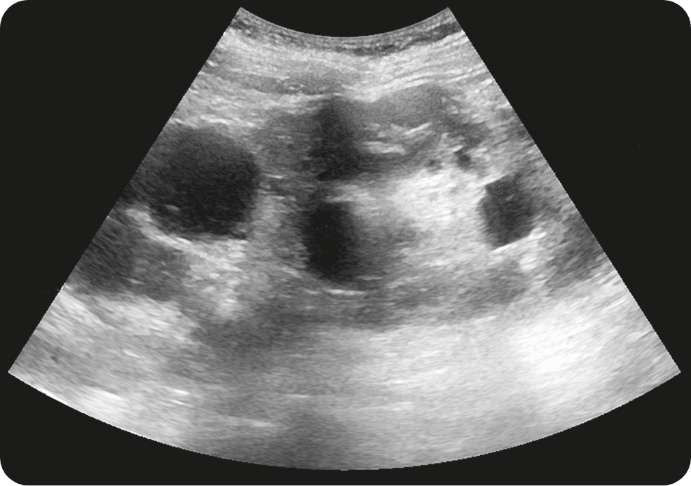 Ultrasound to measure kidney length