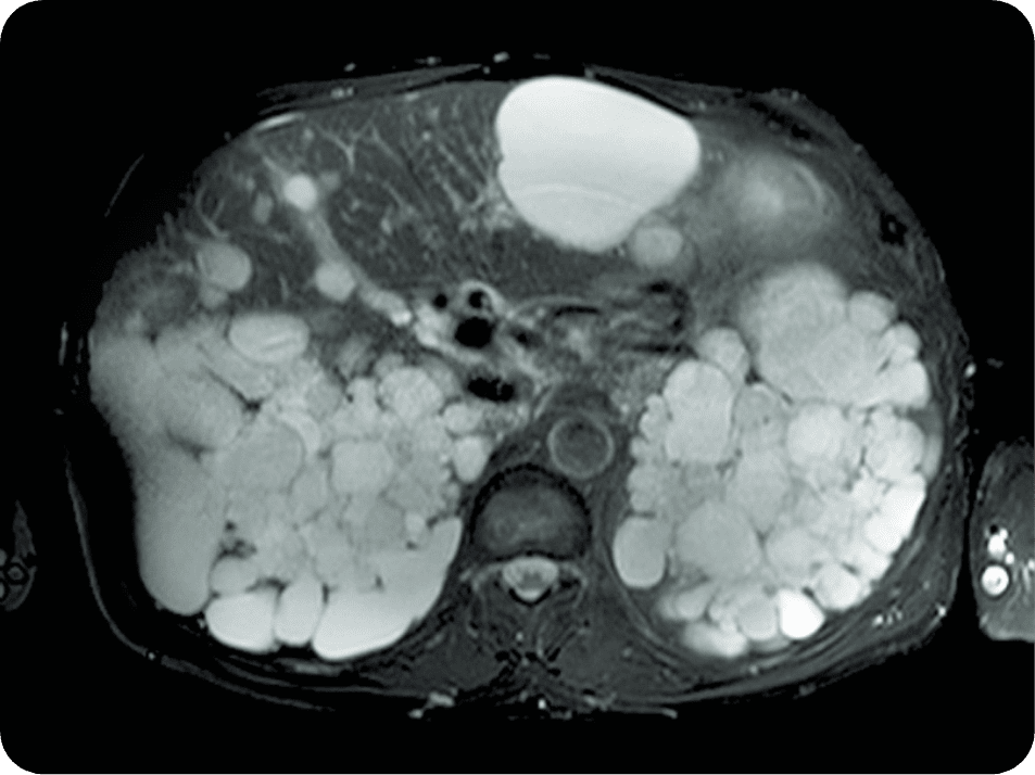 MRI for detailed picture of total kidney volume (TKV)